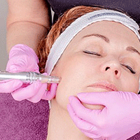 Microneedling